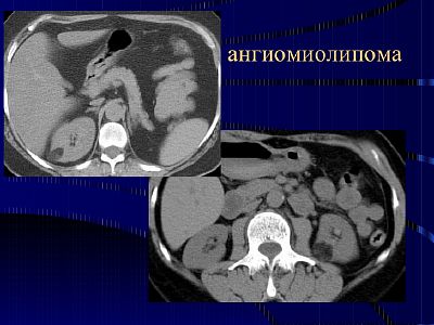 Ангиомиолипома почки