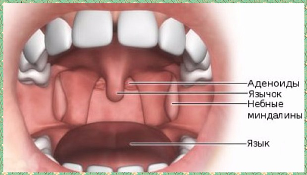 Аденоиды и их лечение