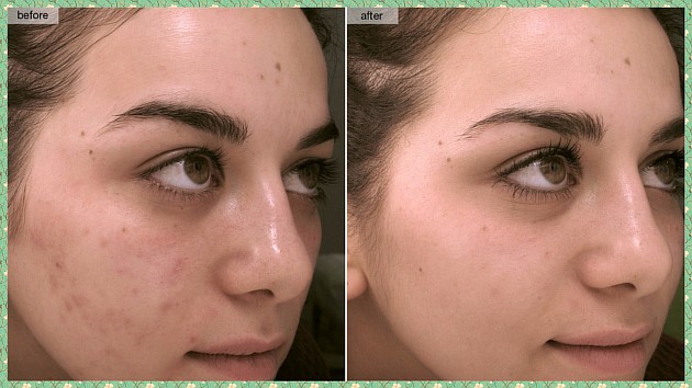 Лечение постакне