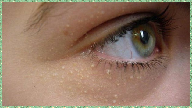 Атеромы под глазами