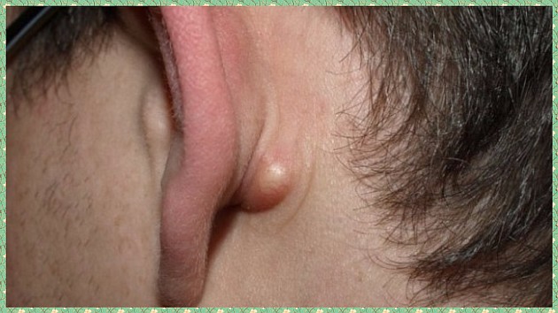 Липома за ухом