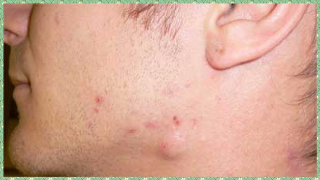 Липома на шее