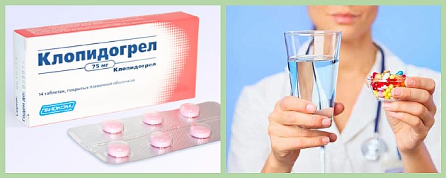 Атеросклерозные лекарства