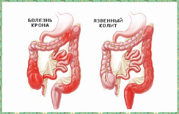 Жизнь с язвенным колитом и болезнью крона