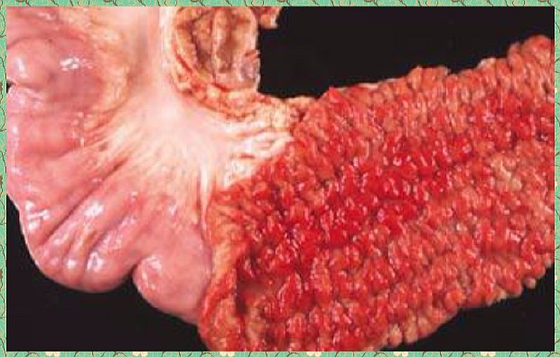 Жизнь с язвенным колитом и болезнью крона