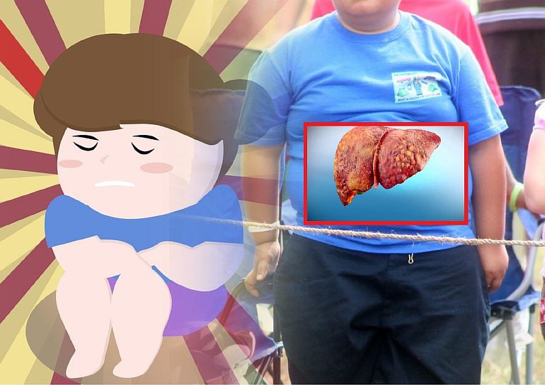 Безалкогольный цирроз печени, навстречу новой эпидемии