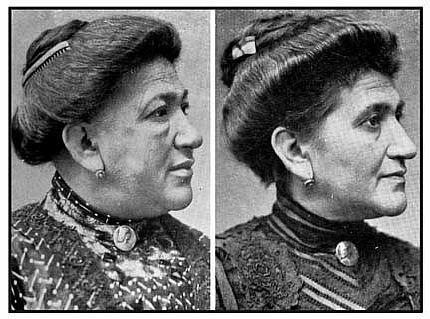 Признаки гипотиреоза