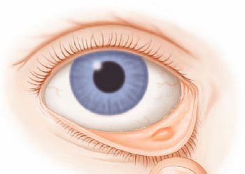 Симптомы и причины халязиона