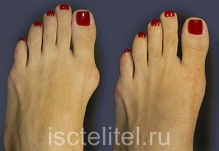 Деформация косточки большого пальца ноги