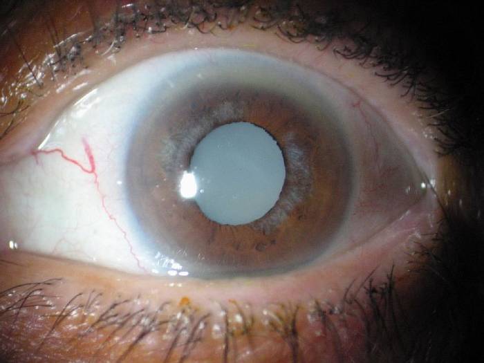 Лечебные процедуры для катаракты