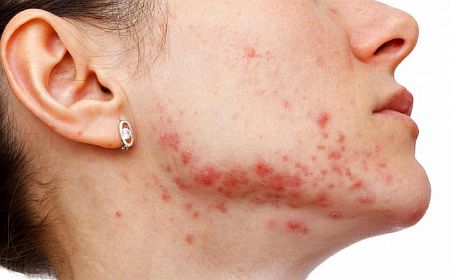 Стафилококк