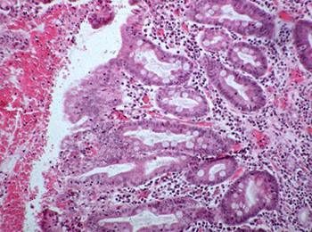 Метаплазия