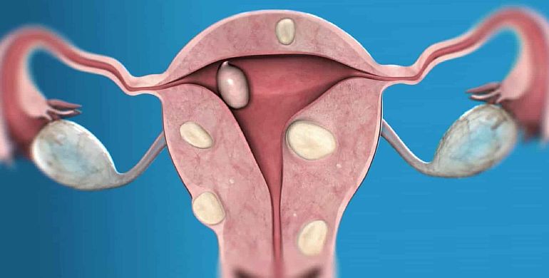 Как лечат миомы