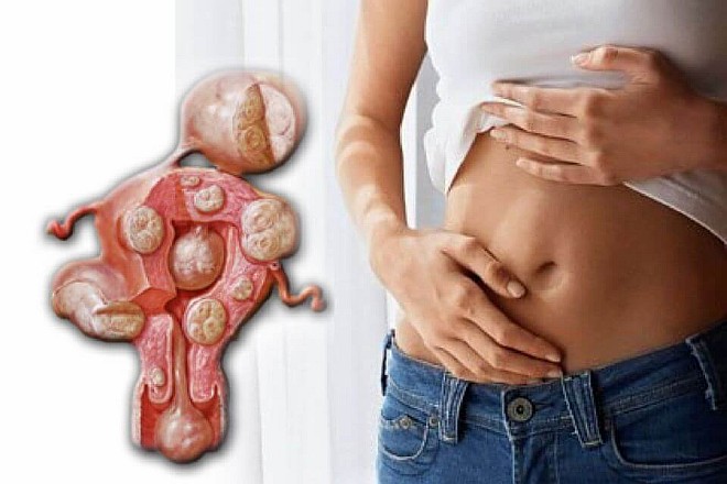 Можем ли мы предотвратить миому матки