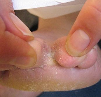 Мозоль между пальцами ног