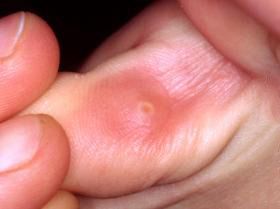 Стержневая мозоль