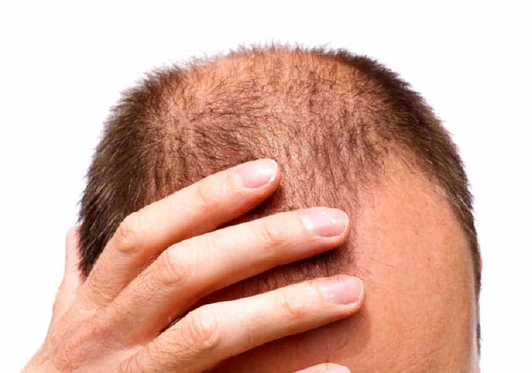 Алопеция: причины и способы лечения выпадения волос