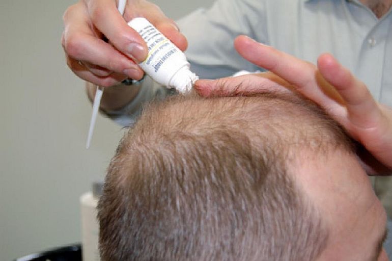 Алопеция: причины и способы лечения выпадения волос