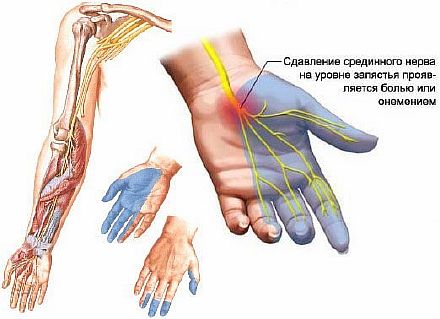 Онемение конечностей