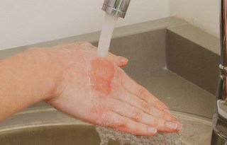 Первые действия при ожоге