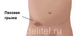 Паховая грыжа у девочек