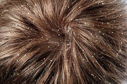 Лечение перхоти народными средствами