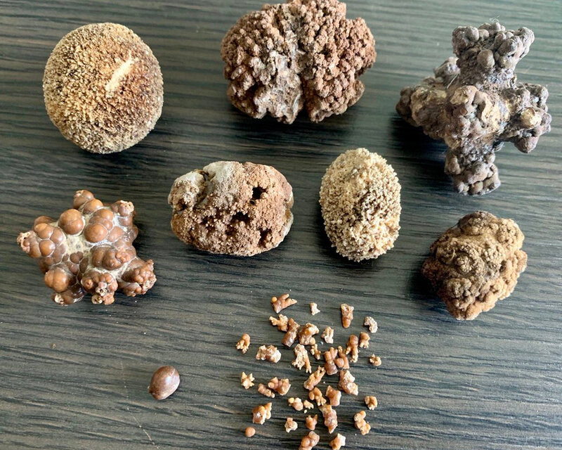 Камни в почках: причины, симптомы и лечение