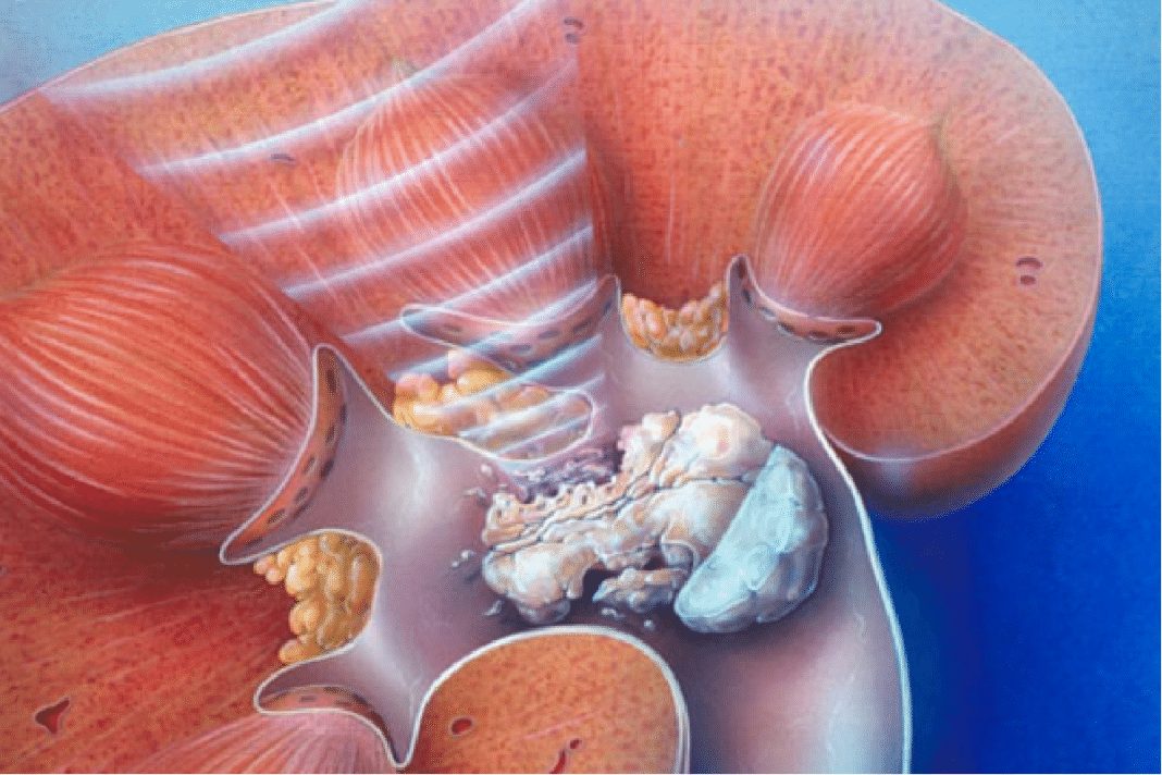 Камни в почках: причины, симптомы и лечение
