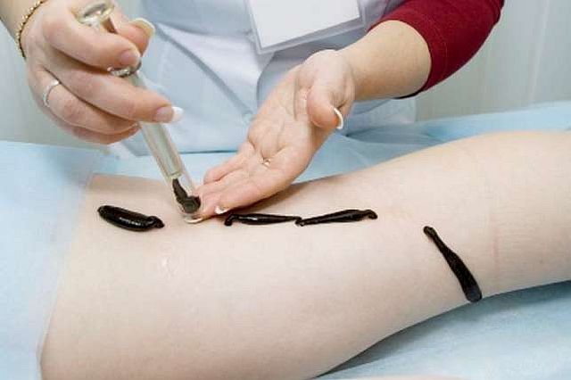 Гирудотерапия: терапия пиявками