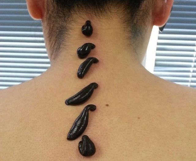 Гирудотерапия: терапия пиявками