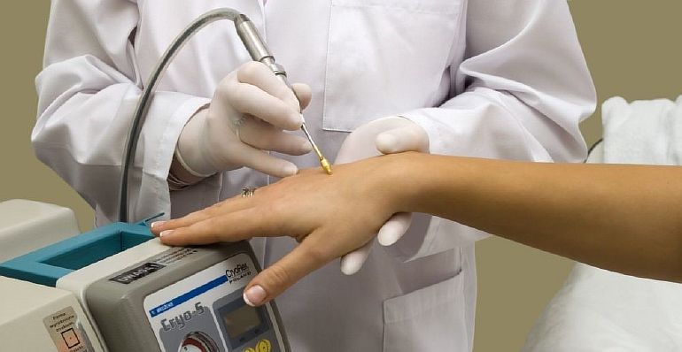 Лечение и профилактика подошвенных бородавок