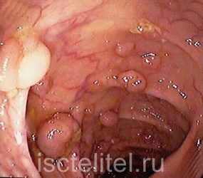 Полип в желудке