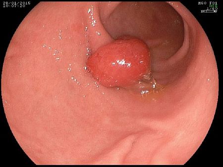 Лечение полипов в желудке народными средствами