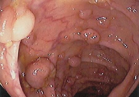 Причины появления полипов в желудке