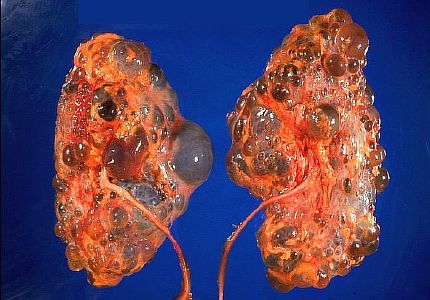 Лечение поликистоза