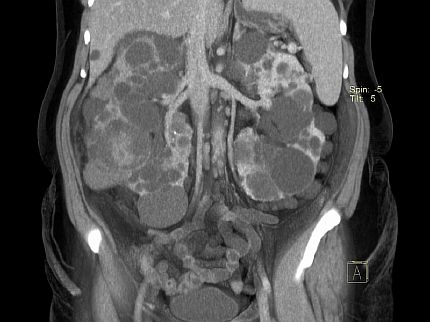 Диагностика поликистоза