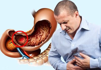 Язва привратника желудка