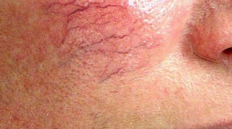 Как лечить розацеа и покраснение лица