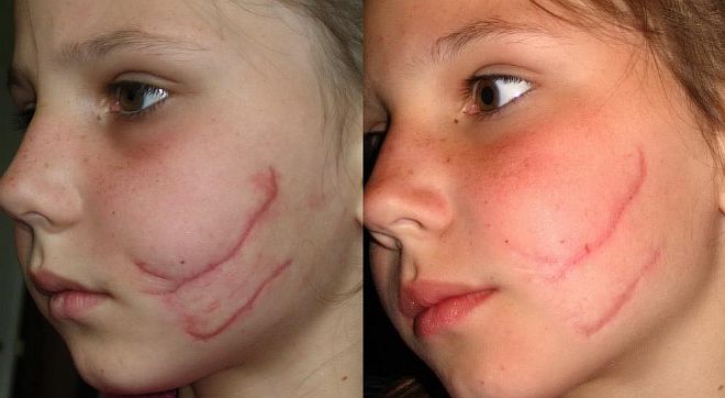 Предотвращение образования рубцов