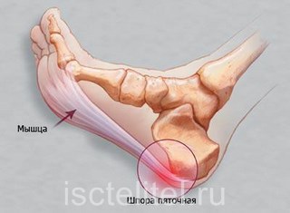 Способы лечения пяточной шпоры