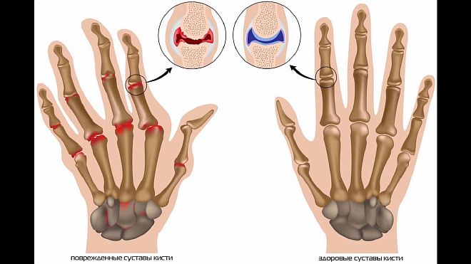 Боль в суставах (полиартралгия): понимание, причины