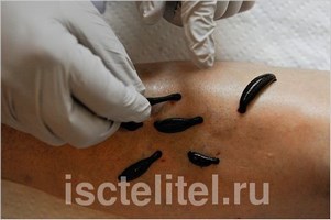 Гирудотерапия при тугоухости