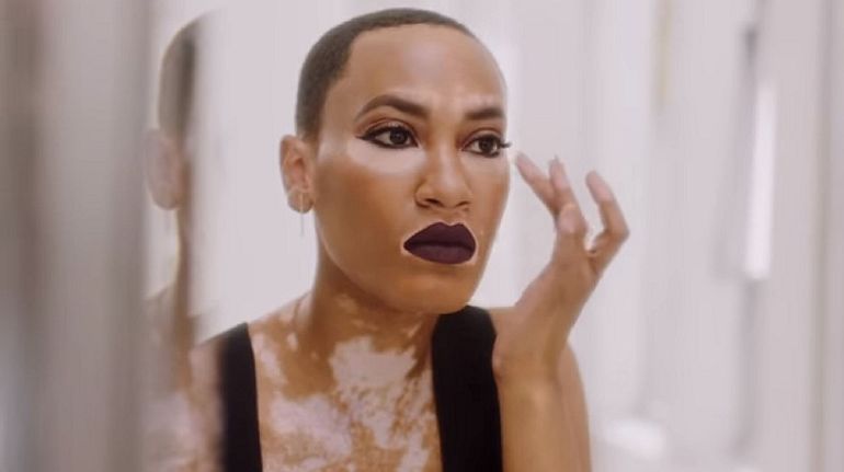 Витилиго - доброкачественный дерматоз