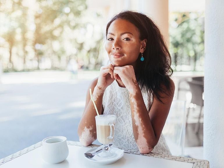 Витилиго - доброкачественный дерматоз