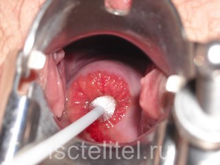 Способы лечения эрозии шейки матки