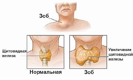 Зоб щитовидной железы