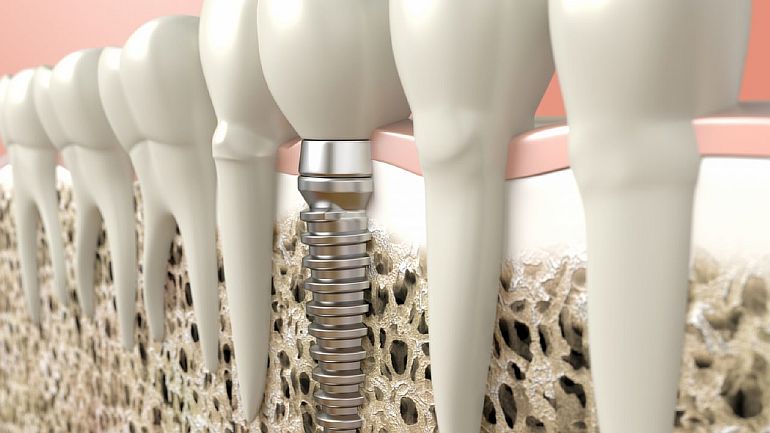 10 заблуждений о зубных имплантатах