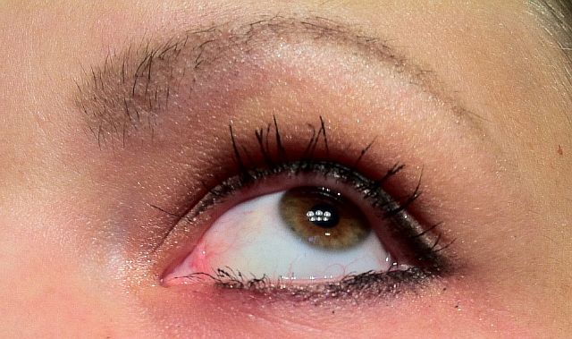 Конъюнктивит: симптомы, причины и лечение