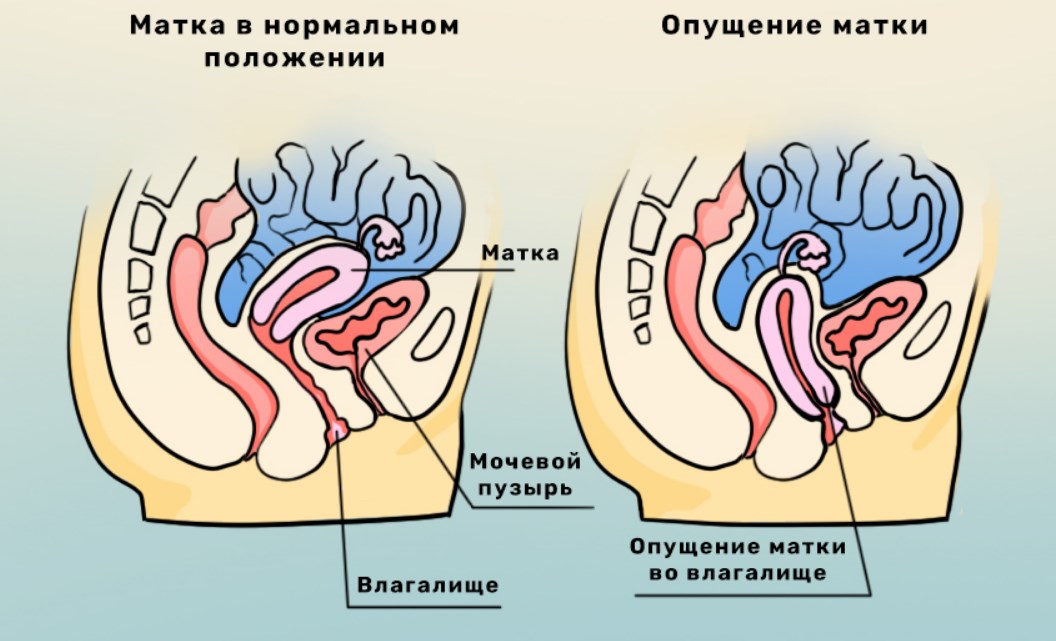 Диагностика опущения матки