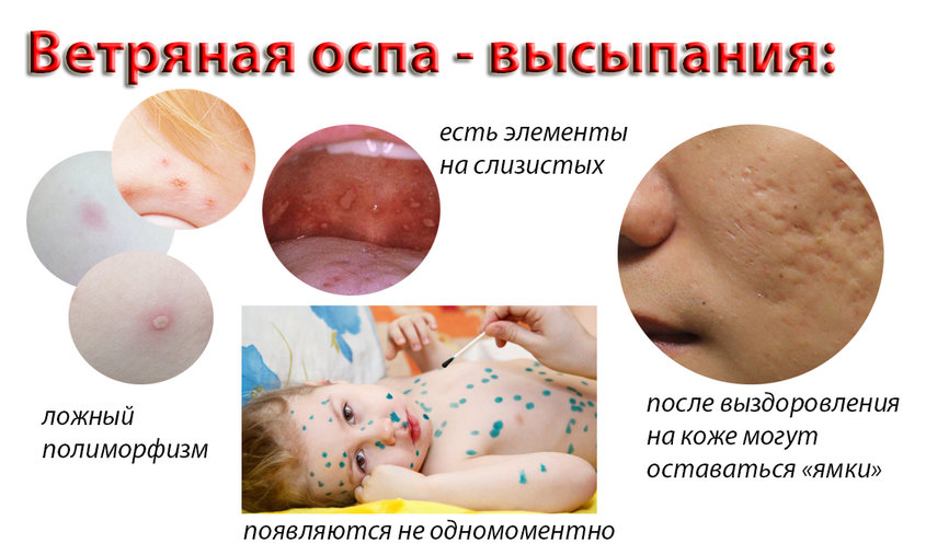 Проявления болезни ветрянки Болезнь ветрянка